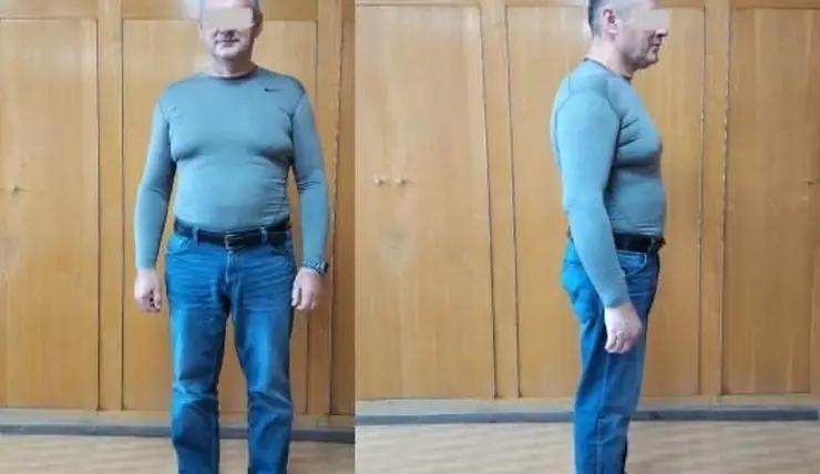 Красноярец похудел на 42 килограмма после операции по уменьшению желудка