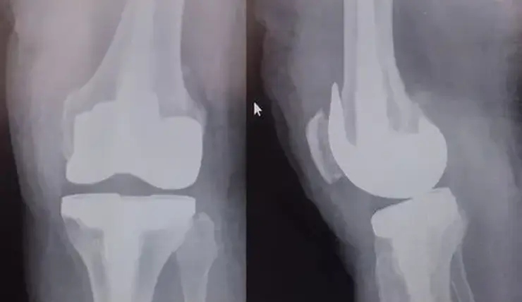 Красноярские врачи начали делать сложные операции по протезированию суставов после переломов