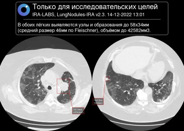 В Красноярском онкодиспансере протестировали искусственный интеллект на возможность диагностировать рак