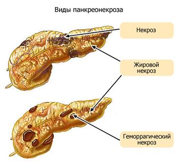 Диета при панкреатите