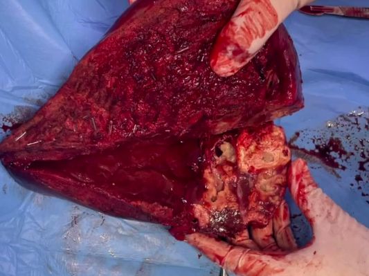 Красноярские врачи спасли мужчину с редким паразитом в печени