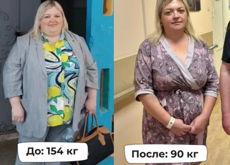 Красноярка сделала бариатрическую операцию и похудела на 64 кг за 8 месяцев