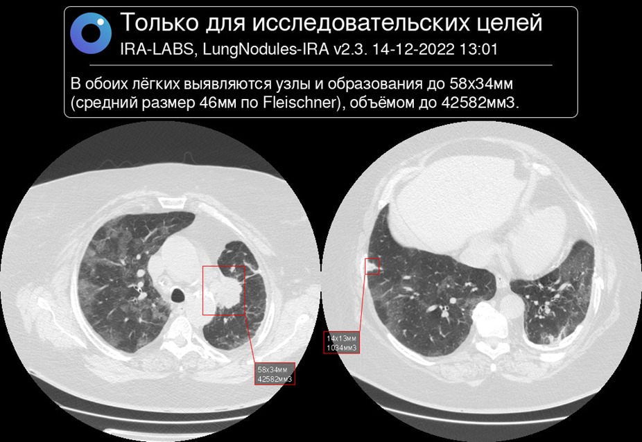 Красноярские медики могут использовать искусственный интеллект для ранней диагностики рака легкого