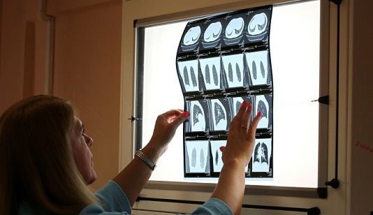 В Красноярском крае резко упала заболеваемость туберкулезом — у детей почти на четверть